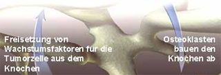 Knochenabbau Teil